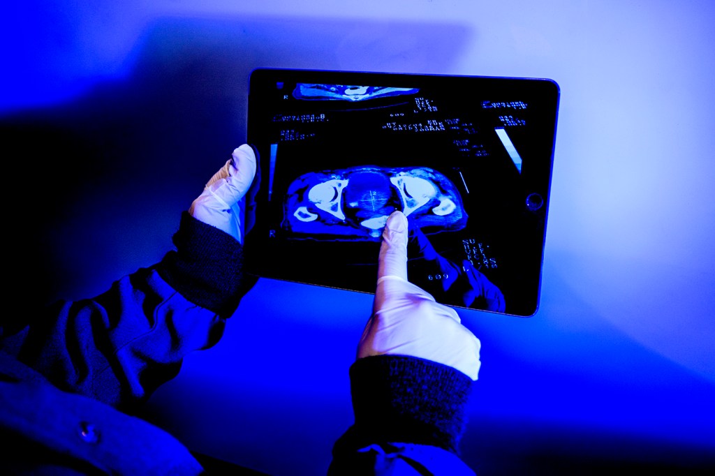 Person pointing to a prostate cancer screening.