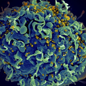 An electron microscope image that shows a human T cell, in blue, under attack by HIV, in yellow, the virus that causes AIDS.