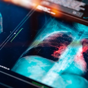 An x-ray image shows a person's lungs, spine, and ribs.